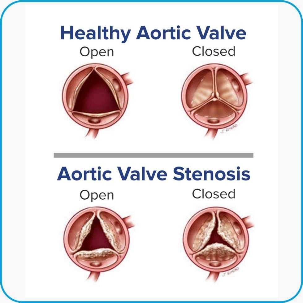 Cardiologist Dr Abhishek Saves 80-years Old’s Life By Performing TAVR ...